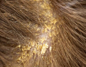seborrhea on dog skin