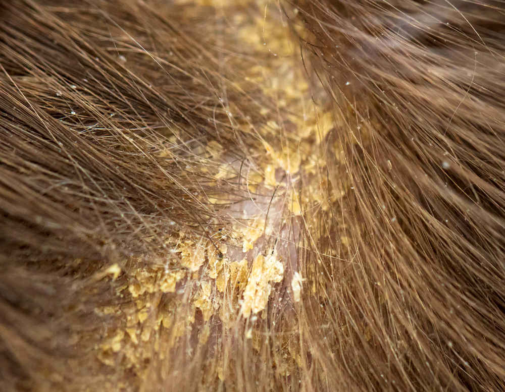 Seborrhea causing dandruff, flakes, or greasy skin