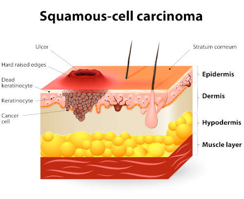 illustration showing squamous cell carcinomas