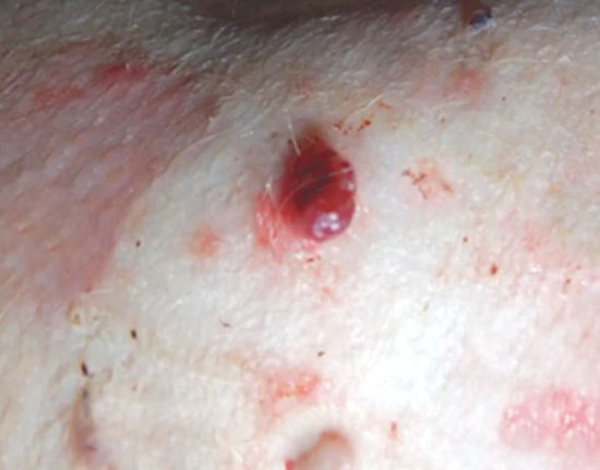 how long will a dog with untreated skin hemangioma hemangiosarcoma