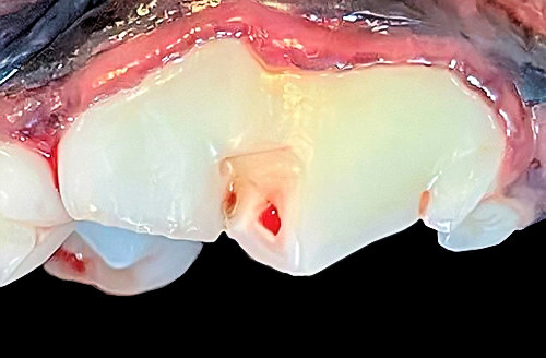 example of cracked tooth due to tooth abscess