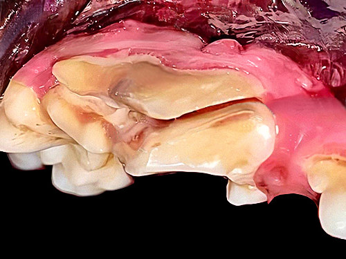 second example of cracked tooth due to tooth abscess