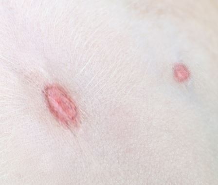 red, circular lesions due to gnat bites
