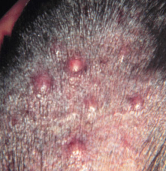 papules as a symptom of folliculitis 