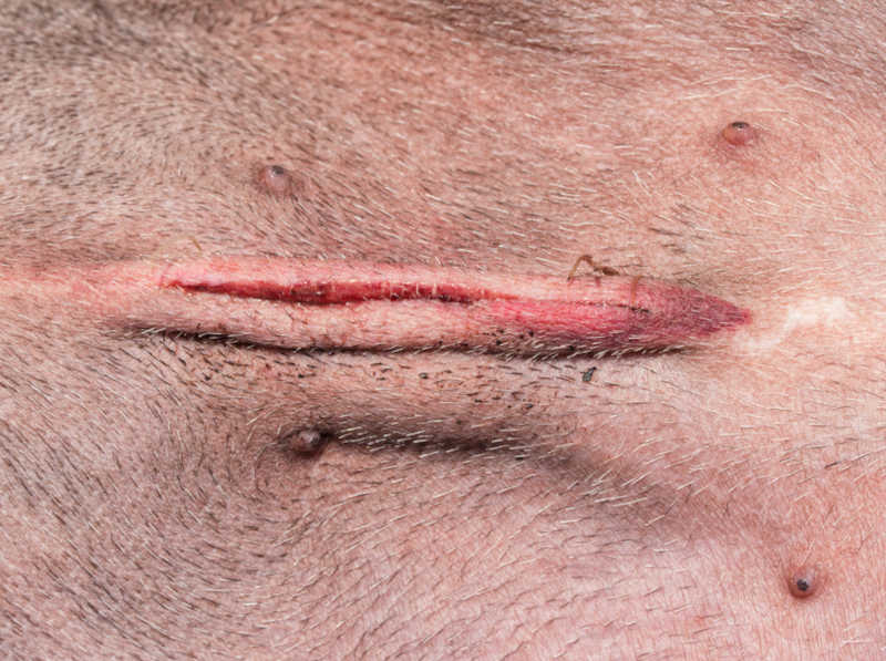 close up of an incision on a dog's abdomen 1 day after spay surgery showing the ends of the stitches