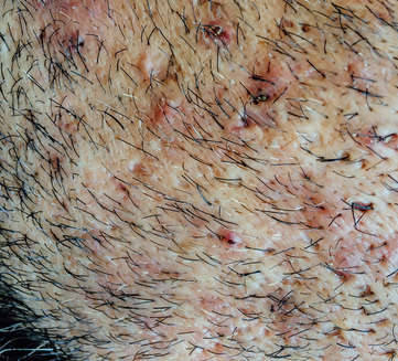 many ingrown hairs on white skin