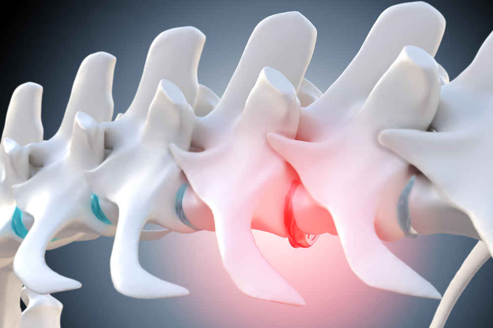 3d illustration of a degenerated prolapsed intervertebral-disc