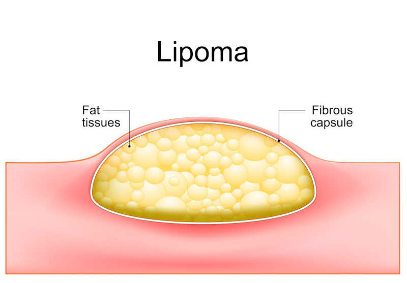 drawing showing the fat tissues forming lipomas