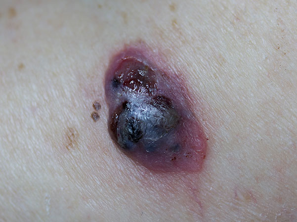 potential melanoma