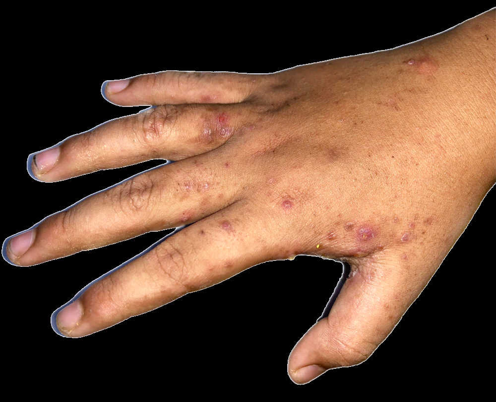 is scabies in dogs contagious to humans