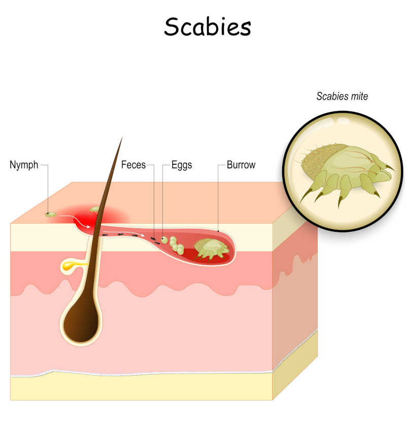 drawing showing where scabies live