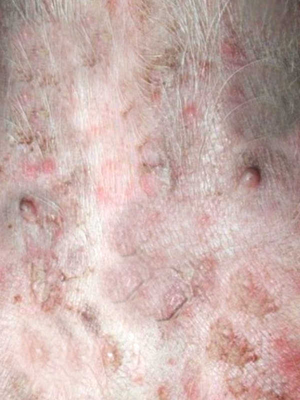 pustules as a symptom of folliculitis 