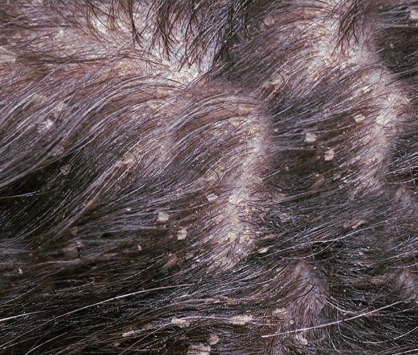 what is walking dandruff on a dog