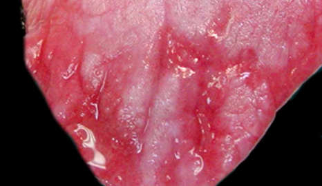 tongue ulcers after contact with bleach